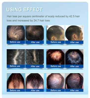 650nm Lllt Technology Hair Laser Regrowth Cap Both In Men And Women