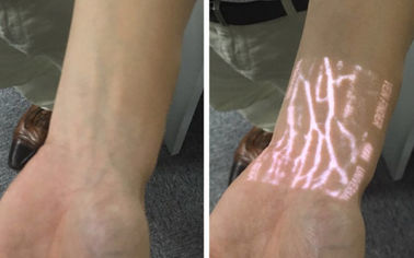Medical Professional Infrared Vein Viewer Transilluminator Find Veins For Phlebotomy
